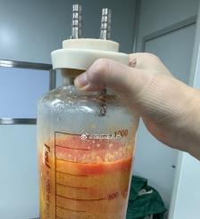 汕头水动力吸脂手术要做多久？